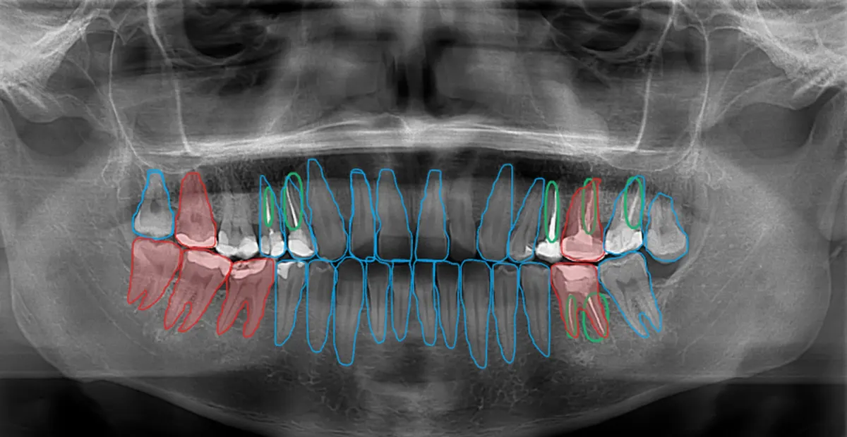Radiografia panorâmica com os dentes contornados pela IA e pontos de atenção em destaque