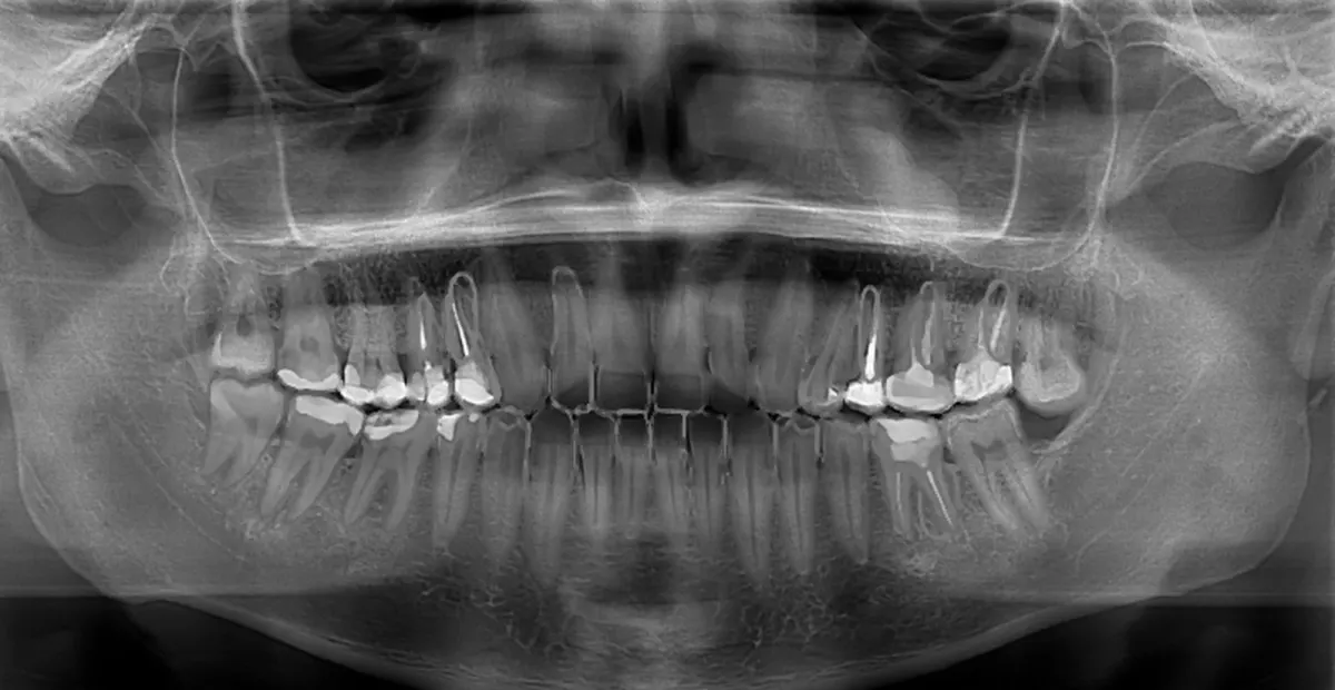 Radiografia panorâmica sem marcações